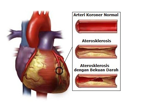 Aterosklerosis dan Penyakit Arteri Koroner dapat menyebabkan