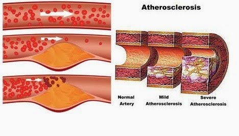 Aterosklerosis dan Penyakit Arteri Koroner yang paling sering