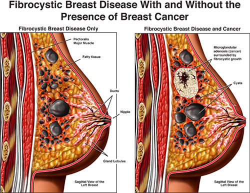 Penyakit Payudara Fibrocystic - Gejala dan Pengobatannya mudah dideteksi