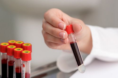 Tes Darah dan Jenisnya Tes darah seringkali diperlukan oleh